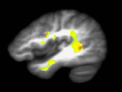 marijuana brain damage